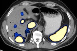 2013 08 09 12 55 01 360 2013 08 12 Abdo Oncology Thumv