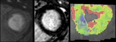 In a 65-year-old man presenting with angina, CT perfusion (right) shows ischemia in the inferolateral wall of the myocardium, but no infarction. CT perfusion also shows myocardial blood flow (MBF) reduced while myocardial blood volume (MBV) is well-preserved. All images courtesy of Dr. Konstantin Nikolaou.
