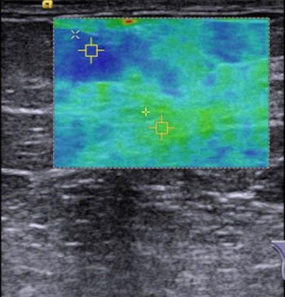 VTIQ image of a healthy breast showing fatty tissue (1.38 m/sec) and parenchyma (3.33 m/sec). Image courtesy of Dr. Michael Golatta.