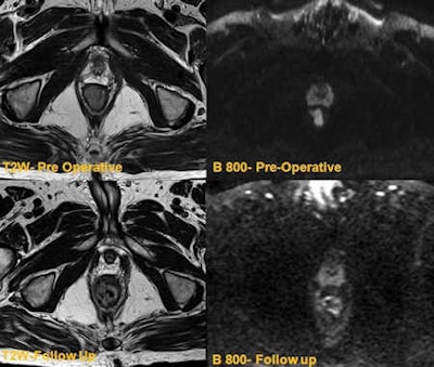 The top row shows low rectal tumor with restricted diffusion. The bottom row shows follow-up T2-weighted image demonstrating minor residual mucosal thickening. DWI shows no residual restricted diffusion, indicating post-treatment scarring.