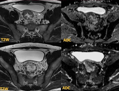 The initial biopsies showed tubulovillous adenoma with no invasion. MRI demonstrates tumor in the sigmoid (upper row) with restricted diffusion. The lower row of images at the rectosigmoid shows T2 high-signal lesion with T2 shine-through effect on the apparent diffusion coefficient (ADC) map -- tubulovillous adenoma. Targeted biopsies confirmed adenocarcinoma, and the patient required chemotherapy before surgery.
