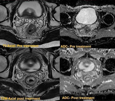 The top row shows circumferential tumor with significant restricted diffusion. The bottom row was obtained following downstaging chemoradiotherapy, which confirmed complete response. There is no residual tumor on postresection histology.