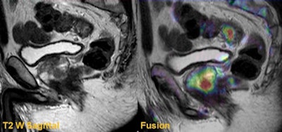 Sagittal T2-weighted and fusion images from a rectal staging examination show an upper rectal tumor. Fusion images also identified a clinically significant prostate cancer that had a significant impact in radiotherapy and treatment planning.