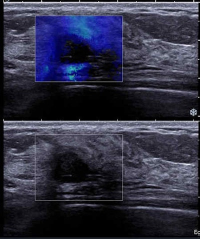 Sonogram shows round mass