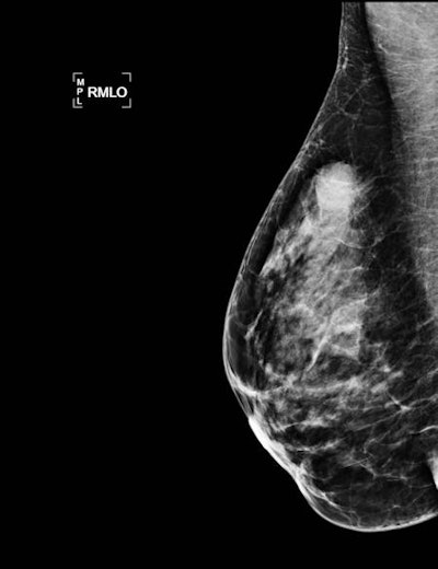 A 33-year-old woman with 15-mm palpable lump in right breast. Top: Mammogram (mediolateral oblique view) shows an oval-shaped mass with indistinct margins. Bottom: Sonogram with shear-wave elastography shows a round mass with hypoechogenicity, abrupt interface, posterior acoustic enhancement, and a low color rating. All the benign criteria (oval mass, circumscribed margin, etc.) are not filled for fibroadenoma. This is categorized as BI-RADS 4. Biopsy under ultrasound guidance: grade III triple-negative (TN) ductal invasive carcinoma (estrogen-negative, progesterone-negative, HER2-negative cancer). TN cancers may have pseudobenign imaging features and be classified BI-RADS 3.