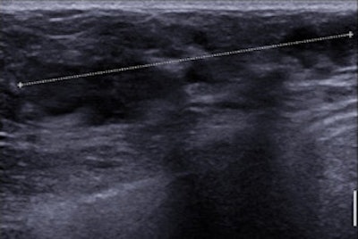 Sonogram shows no mass