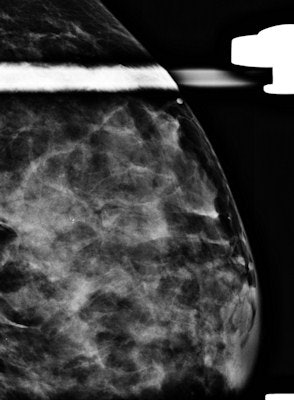 A 34-year-old woman with 50-mm suspicious palpable lump in the left breast. Top: Mammogram (lateromedial view, spot compression). It shows no mass, no architectural distortion, just three microcalcifications. Bottom: Sonogram shows no mass but a focal heterogeneity ('nonmass'). BI-RADS 4. Biopsy under ultrasound guidance: grade III ductal invasive carcinoma HER2+. All images courtesy of Dr. Martine Boisserie-Lacroix.