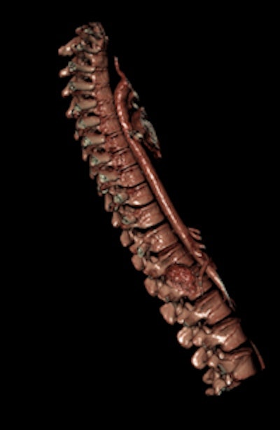 Visualization of the vertebral column, which is not straightforward in a classical autopsy because dissection of the spine is time-consuming and involves the sawing of the spinous process of vertebral bodies.