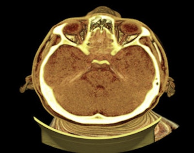 This image demonstrates the capabilities of digital autopsy in the head and neck. In cases of shaken baby syndrome, retrobulbar hemorrhages can be diagnosed.