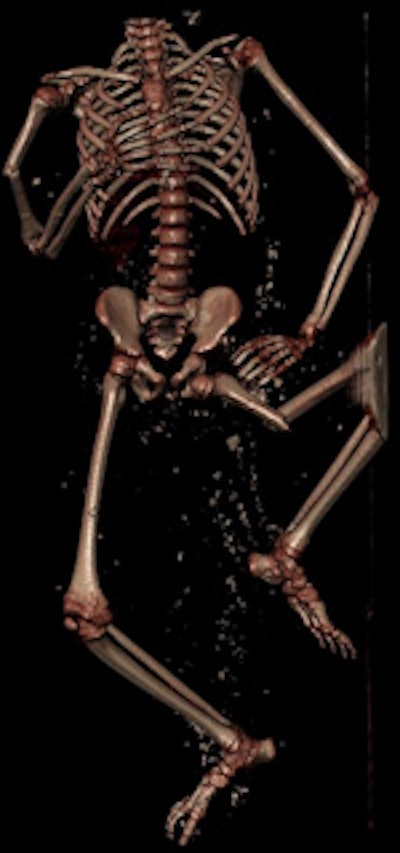 A 15-year-old boy was fatally injured in a landslide that destroyed a building. Left: External deformity of right upper limb corresponding to underlying compound fracture of the humerus. External deformity of left lower limb, corresponding to underlying compound fracture of the femur. Middle: Digital autopsy shows muscle lacerations. Right: Digital autopsy shows bone fractures. All images courtesy of Dr. Pramod Bagali and Matt Chandran.