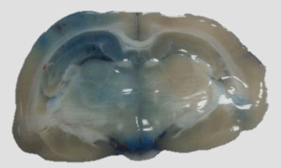 Extravasation of blue dye into brain tissues is observed in the left side of the brain that was sonicated with ultrasound using the SonoCloud device.
