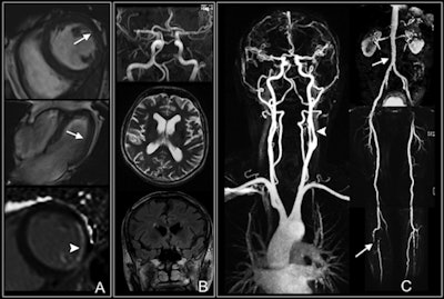Whole-body MRI shows multiple findings in a 74-year-old man with type 2 diabetes for 21 years. Cardiac images (A) show impaired function with anterolateral hypokinesia (arrows). Late gadolinium-enhanced image (bottom) shows enhancement of anterolateral myocardium (arrowhead) indicative of myocardial infarction. Cerebral images (B) show normal cerebral arteries. Vascular images (C) demonstrate 50% stenosis of left internal carotid artery (arrowhead) and luminal irregularities of the abdomen (upper arrow), thighs, and lower leg with severe atherosclerotic disease and vessel occlusion (lower arrow). Images courtesy of Radiology.