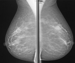 A 56-year-old woman without a family history of breast cancer had a negative screening mammogram. MRI screening revealed a large, nonpalpable breast cancer in the immediate retro-areolar region of the left breast readily picked up by the maximum intensity projection (MIP) image (below). All images courtesy of Dr. Christiane Kuhl.