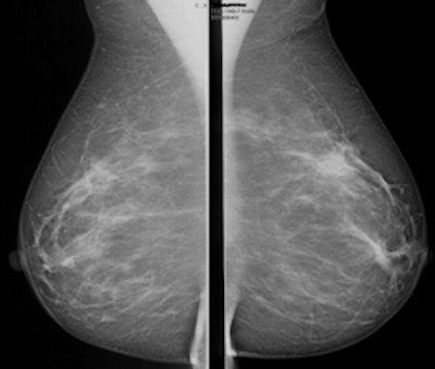 Mammography