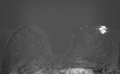 These two first postcontrast subtracted (FAST) images are from the same patient.