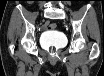 Image from MDCT cystography acquisition in a 73-year-old postoperative patient after robot-assisted laparoscopic radical prostatectomy shows sufficient bladder distension and opacification of a minimal extraperitoneal leak at the vesico-urethral anastomosis (arrow). Applied with care in the early postoperative setting, this technique can allow confident detection or exclusion of urine extravasation indicating lower urinary tract injury both spontaneous (such as in colovesical fistulas from diverticulitis) and iatrogenic.