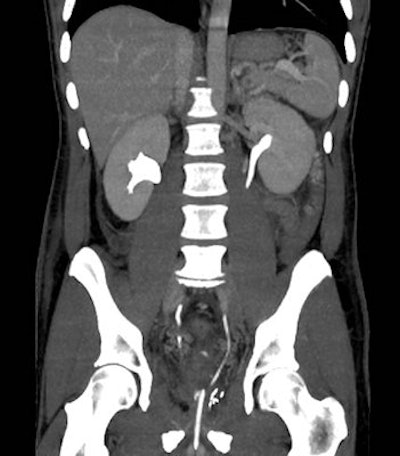 Image from a triple-bolus MDCT urography acquisition in a 45-year-old postoperative patient shows simultaneous imaging of arterial, parenchymal, and excretory phases. This technique combined with preliminary unenhanced scans can allow time- and dose-efficient, reliable investigation of suspected iatrogenic injuries, including assessment of extraluminal blood, abnormal collections, active bleeding, urinary extravasation, and venous patency. All images courtesy of Dr. Massimo Tonolini.