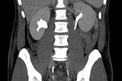 2013 09 16 11 06 28 274 2013 09 16 Ct Prostatectomy Fig1 20130916180706