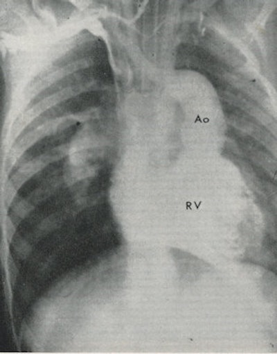 Venous angiocardiogram in a patient with transposition of the great vessels. The aorta (Ao) originates from the right ventricle (RV).
