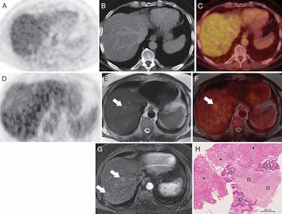 Images are of a 66-year-old man at follow-up for colorectal cancer. PET (A), CT (B), and PET/CT (C) images show no lesions. However, PET (D), T2-weighted MRI (E), and fused PET/MRI (F) show two liver metastases (arrow) that were confirmed on contrast-enhanced ultrasound and biopsy. The patient underwent radiofrequency ablation with ultrasound guidance. Images courtesy of Radiology.