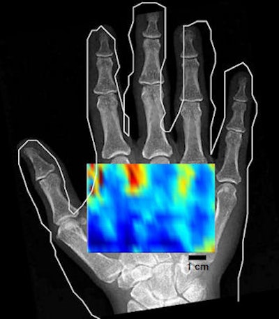 An in vivo low-resolution C-mode noncontact image of a hand shows varying contrast between the anatomy containing mainly bone and that containing only soft tissue.