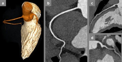 A 28-year-old woman who was referred for CCTA because of paroxysmal arrhythmia. The examination was performed during free breathing with a tube voltage of 80 kVp at a mean heart rate of 51 bpm, resulting in a dose length product of only 24 mGycm. All images courtesy of Dr. Bernhard Bischoff.
