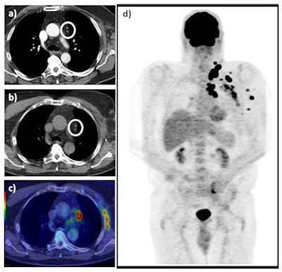 A 73-year-old man with previous recurrent stage IIIC disease was found to have an enlarged fine needle aspiration positive, left supraclavicular lymph node on clinical follow-up. A staging CT revealed presumed postsurgical changes in the left axilla and a couple of sub-5mm mediastinal lymph nodes (white circle) (a). A subsequent FDG PET/CT revealed FDG-avid left axillary soft-tissue recurrence and intensely hypermetabolic sub-cm nodal disease in the mediastinum (white circle) as seen on the axial unenhanced CT (b) and axial fused PET/CT images (c), in addition to multiple further sites of FDG-avid loco-regional disease as seen on the maximum intensity projection (d). This resulted in change from potential radical surgery to chemotherapy, which represented a major clinical impact. All images courtesy of Dr. Manil Subesinghe.