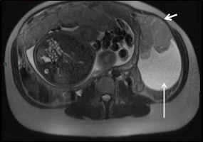 Serous ovarian cystoadenocarcinoma in a 34-year-old woman at 32 weeks gestation presented with acute abdominal pain. Coronal (left) and sagittal (right) T2-weighted MR images show a complex mass, with fluid and solid components (short arrows) on the left ovary.