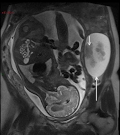 2013 10 03 09 14 24 157 2013 09 27 Pregnancy 2a