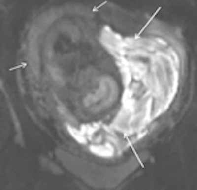 Subchorionic hemorrhage due to placenta abruption in a 30-year-old woman at 29 weeks gestation presented with acute pelvic pain and vaginal bleeding. Left: Coronal T1-weighted gradient-echo image (4.1/1.1, 10° flip angle) shows a large, hyperintense subchorionic hematoma (arrows). Middle and right: The intrauterine hematoma is mildly hyperintense to placenta on the sagittal T2-weighted half-Fourier RARE image (1000/90) (Middle) and markedly hyperintense to placenta on the sagittal diffusion-weighted image (b value, 800 sec/mm2) (right). Note the hematoma has hypo- and hyperintense areas, due to repeated bleeding. Short arrows indicate the placenta. All images courtesy of Dr. Gabriele Masselli.