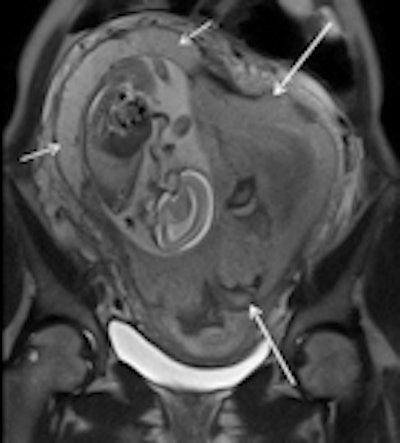 2013 10 03 09 14 26 301 2013 09 27 Pregnancy 1b