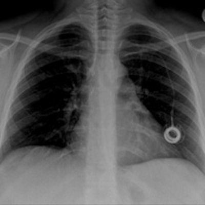 2014 03 09 23 57 42 318 2014 03 10 Cxr Thumb