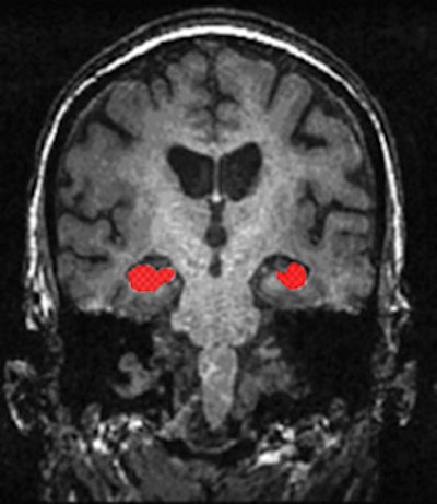 Coronal MRI with outline of the hippocampus. Hippocampus volume is associated with Alzheimer's disease. Image courtesy of Dr. Gabriel Krestin, PhD.