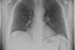 2013 10 02 12 02 27 155 2013 10 03 Bone Suppression Thumb