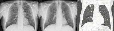 Example case in which the radiologists improved their detection of a 13 mm, pathologically proven, squamous cell carcinoma in the right upper lobe.