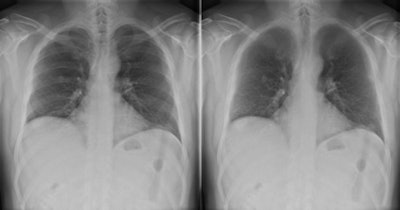 A 12-mm nodule in the right lung is completely obscured by overlying bone structures. The bone suppression software suppressed the ribs and improved the visibility of the nodule. All images courtesy of Dr. Steven Schalekamp.