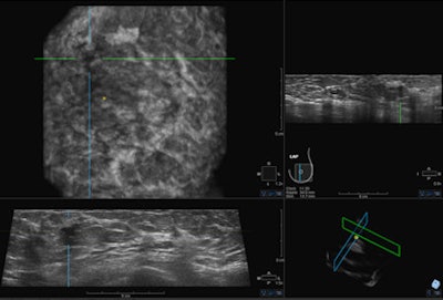Last September the U.S. Food and Drug Administration (FDA) approved the somo-v ABUS device for use in combination with mammography in women with dense breast tissue. This may drive increased interest from physicians in the use of ultrasound as a screening tool. Image courtesy of GE Healthcare.