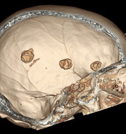 Same patient: Coronal (left) and sagittal (right) 3D reconstructions are shown.