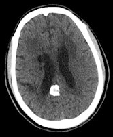 A 60-year-old man known to have HIV presented with seizures. The solid calcifications on noncontrast enhanced CT (NCECT) at the right frontal (left), left basal ganglia (middle), and right parietal areas (right) represent sequela following treatment for documented toxoplasmosis. All images courtesy of Dr. Froilan Celzo.