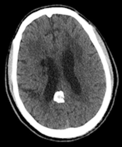 A 60-year-old man known to have HIV presented with seizures. The solid calcifications on noncontrast enhanced CT (NCECT) at the right frontal (left), left basal ganglia (middle), and right parietal areas (right) represent sequela following treatment for documented toxoplasmosis. All images courtesy of Dr. Froilan Celzo.