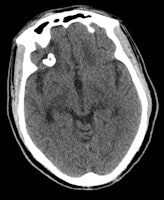 enhanced CT