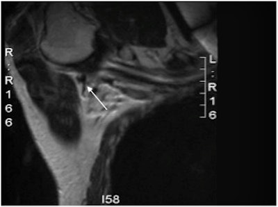 An axillary MRI following the administration of subcutaneous SPIO into the breast (Endorem, Guerbet). The lymphatic tract is seen to go into a lymph node. Image courtesy of Mr. Michael Douek.