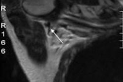 2013 10 11 08 28 17 836 2013 10 11 Axillary Mri 20131011153145