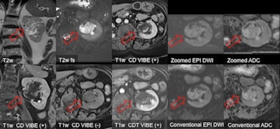 Zoomed EPI-DWI using pTX MRI can allow clearer visualization of transitional cell carcinoma and renal abscess. Images courtesy of Dr. Stefan Haneder.