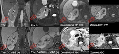 renal abscess