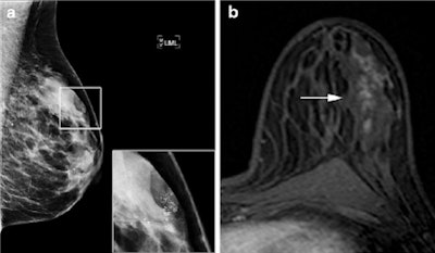 Mammography and breast MRI results of a patient presenting with suspicious microcalcifications on mammography, classified as BI-RADS 4. Mammography (a, left mediolateral view) shows a cluster of microcalcifications which is shown enlarged in the inset. At breast MRI, both observers identified non-mass-like enhancement with a segmental distribution and clumped internal enhancement (b, arrow). Kinetic curve assessment showed a type I curve. The lesion was scored BI-RADS-MRI 4 and BI-RADS-MRI 5, respectively. Histopathology showed DCIS grade 3. All images reproduced from: B.L. Stehouwer, L.G. Merckel, H.M. Verkooijen, et al. 2013. 3-T breast magnetic resonance imaging in patients with suspicious microcalcifications on mammography. Eur Radiol. DOI 10.1007/s00330-013-3029-1.