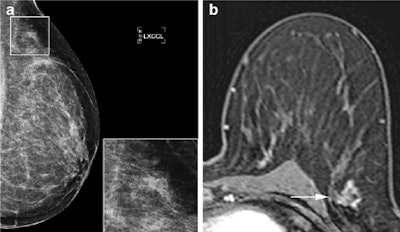 Mammography and breast MRI results of a patient presenting with suspicious microcalcifications on mammography, classified as BI-RADS 4. Mammography (a, left exaggerated lateral craniocaudal view) shows a cluster of microcalcifications which is shown enlarged in the inset. At breast MRI, observer one identified nonmass-like enhancement with a regional distribution, heterogenous internal enhancement (b, arrow), and a type II kinetic curve. Observer two identified a non-mass-like enhancement as well, with a focal distribution, heterogeneous internal enhancement, and a type III kinetic curve. The lesion was scored BI-RADS-MRI 3 and BI-RADS-MRI 4, respectively. Histopathology showed an invasive lobular carcinoma and DCIS grade 1.
