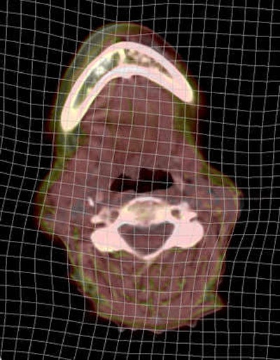 Figure 3: Examination of the deformation grid can facilitate quality assessment by the user. The deformation should be smooth, free from discontinuities, and not contain artificial deformation in areas of homogeneous tissue.