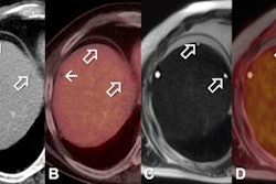 2013 10 31 08 29 48 187 2013 10 31 Liver Metases