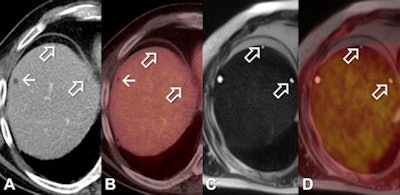 Patient with liver cyst in the liver segment VII identifiable both in PET/CT (A, B) as well as in PET/MRI (C, D). Additional small hypodense liver lesions in segment VIII deemed too small to characterize in PET/CT. In the T2-weighted half-Fourier acquisition single-shot turbo spin-echo (HASTE) in PET/MRI (C, PET/MRI fusion) the lesions exhibit a high signal and well-defined lesion borders and can therefore correctly be identified as liver cysts. Images courtesy of Dr. Karsten Beiderwellen.